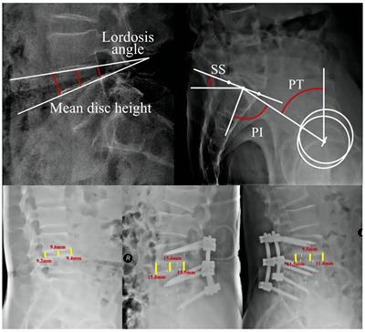 Development and validation of a risk prediction model for cage subsidence after instrumented posterior lumbar fusion based on machine learning: a retrospective observational cohort study